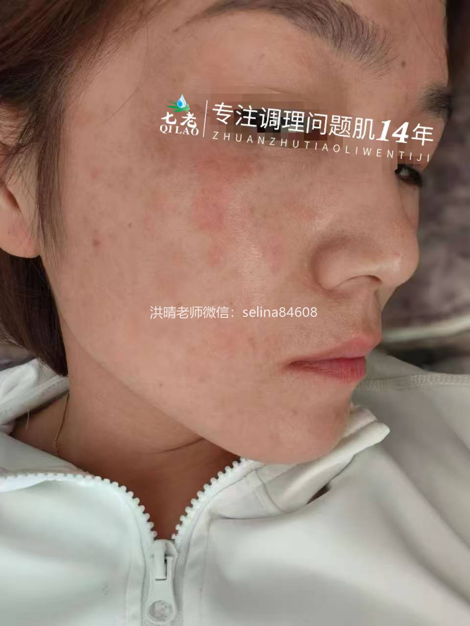 七老反复过敏红痒疹子修护案例