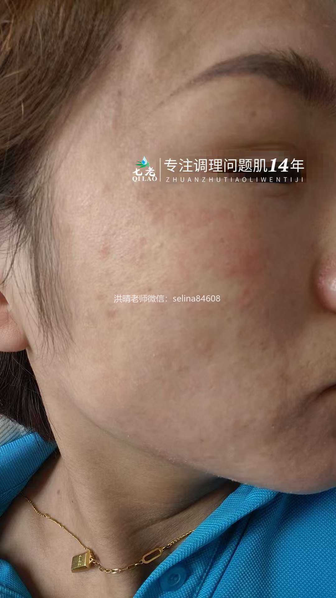 七老反复过敏红痒疹子修护案例