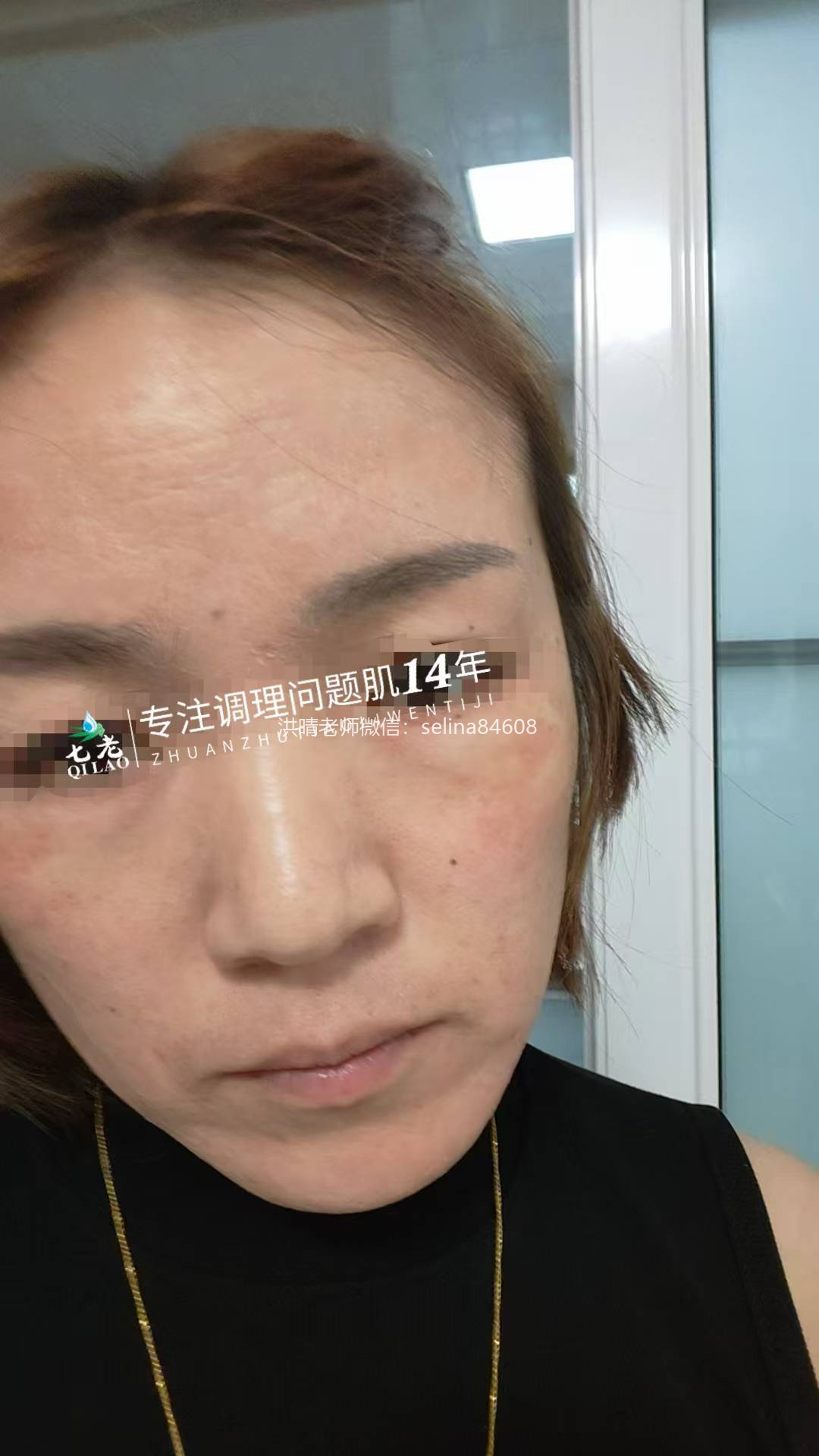 七老反复过敏红痒疹子修护案例