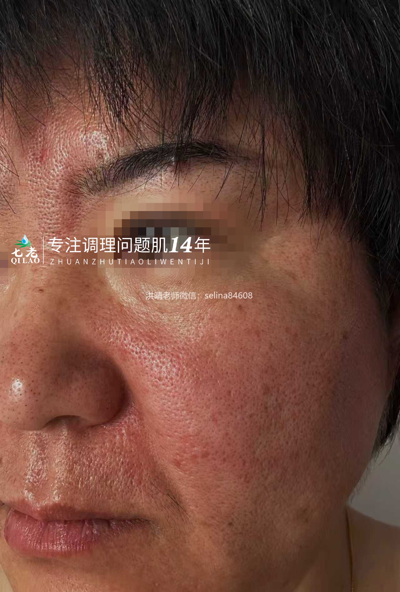 七老严重激素脸玫瑰皮➕脂皮修护案例