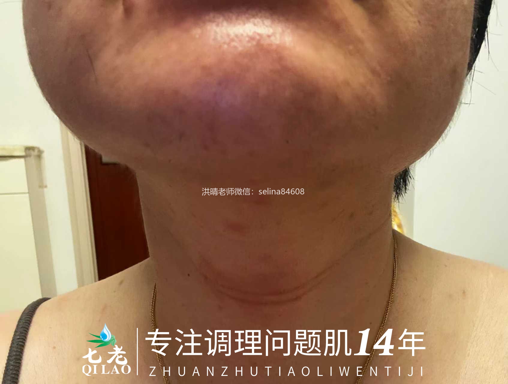 七老严重激素脸玫瑰皮➕脂皮修护案例