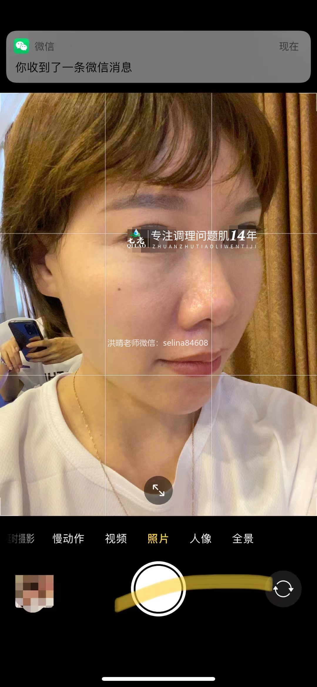 七老玫瑰痤疮正向案例反馈