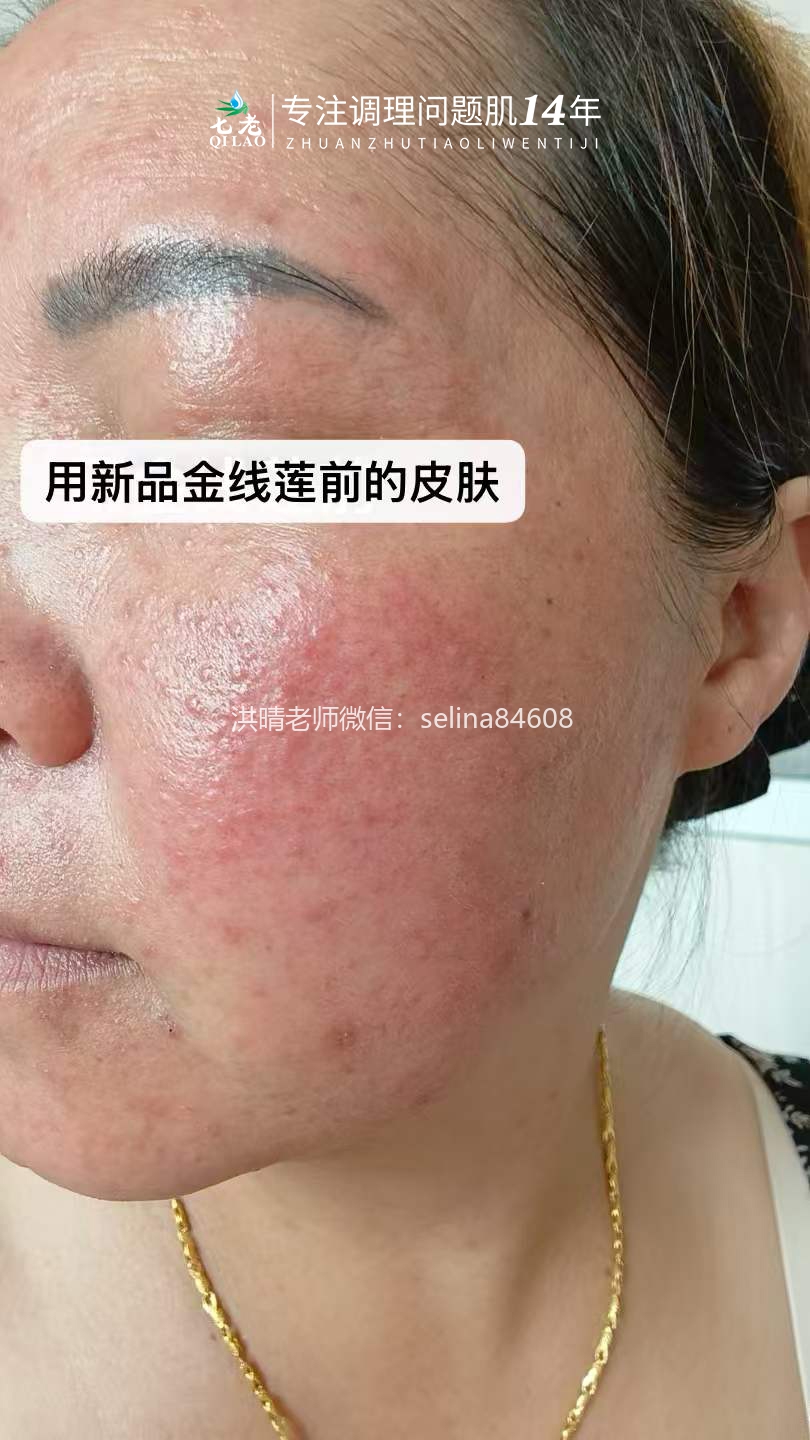 七老金线莲新品内测案例