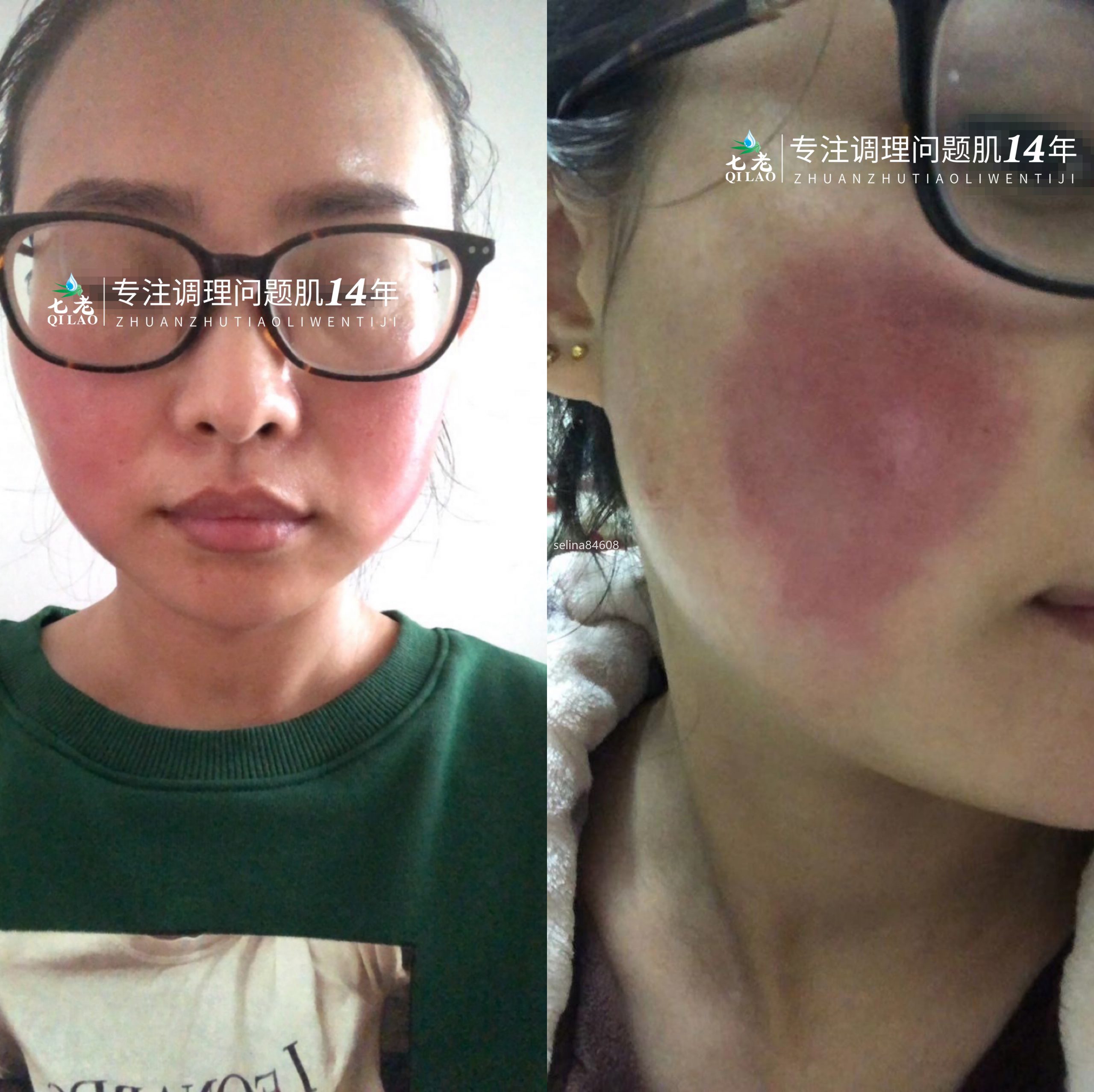 七老重度玫瑰大红脸修护案例