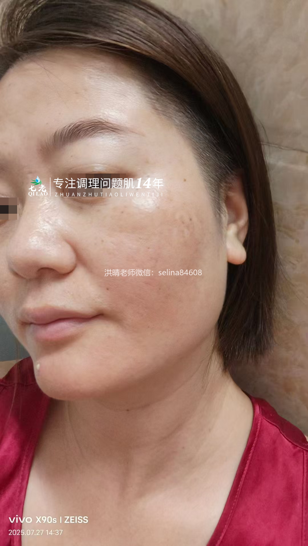 七老激素脸修护案例
