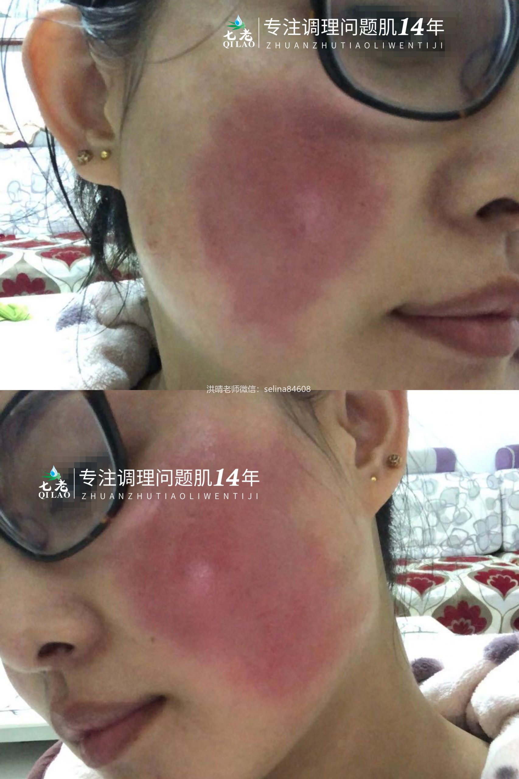 七老重度玫瑰大红脸修护案例