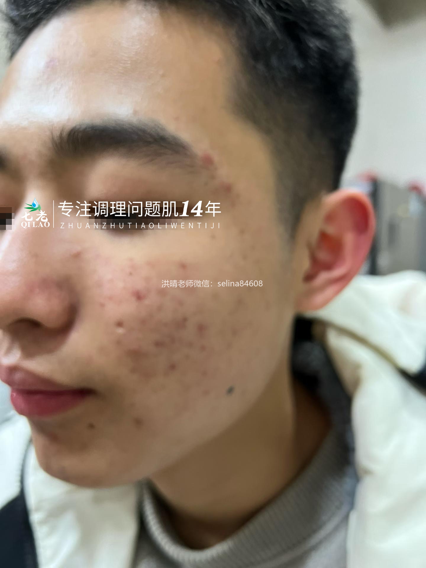 七老青春痘修护调理案例
