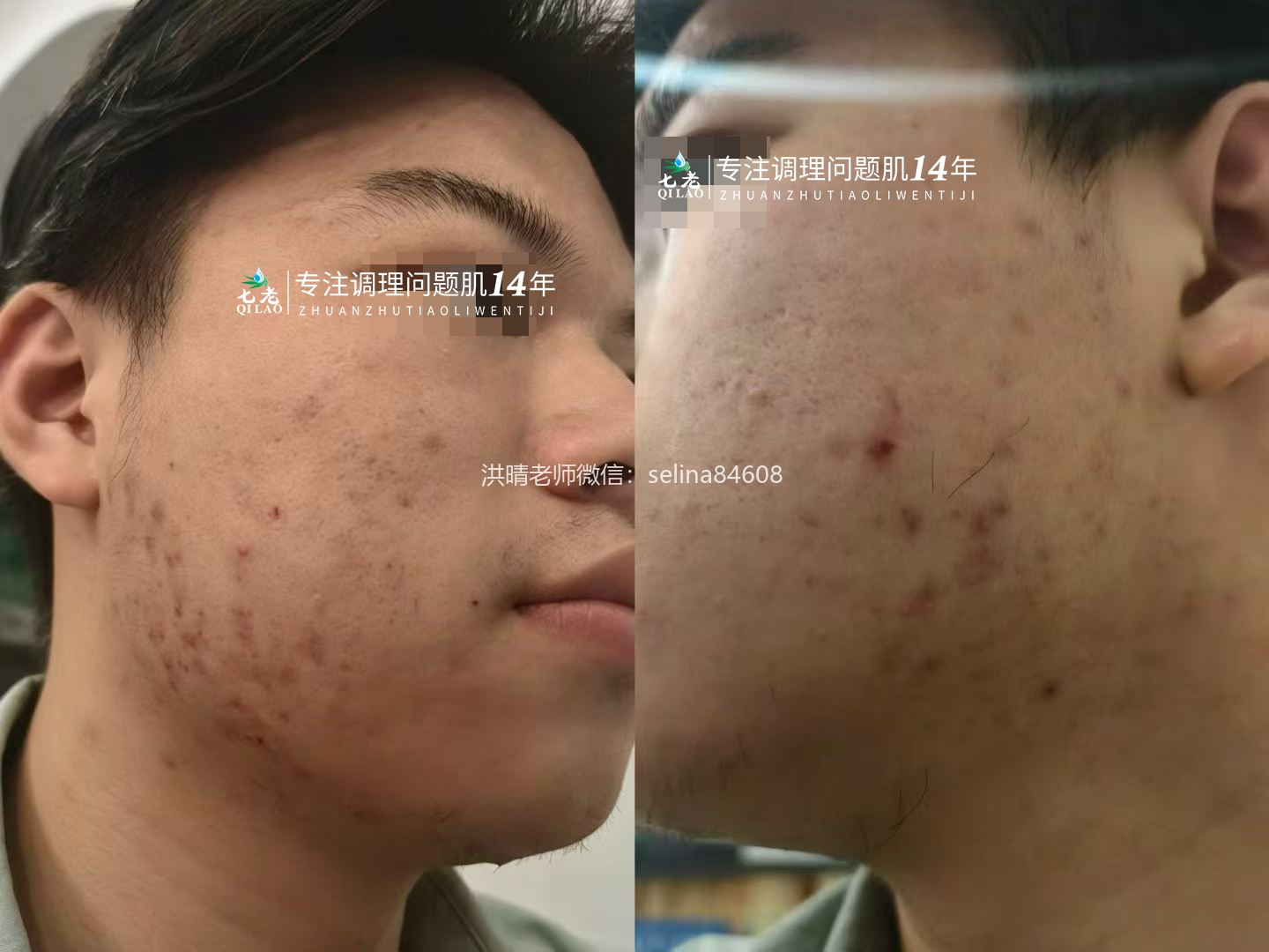七老青春痘修护案例