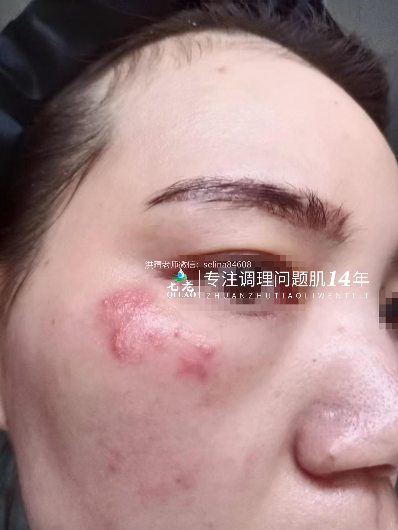 七老新品金线莲内测超级顽固痘痘➕脂皮17天反馈