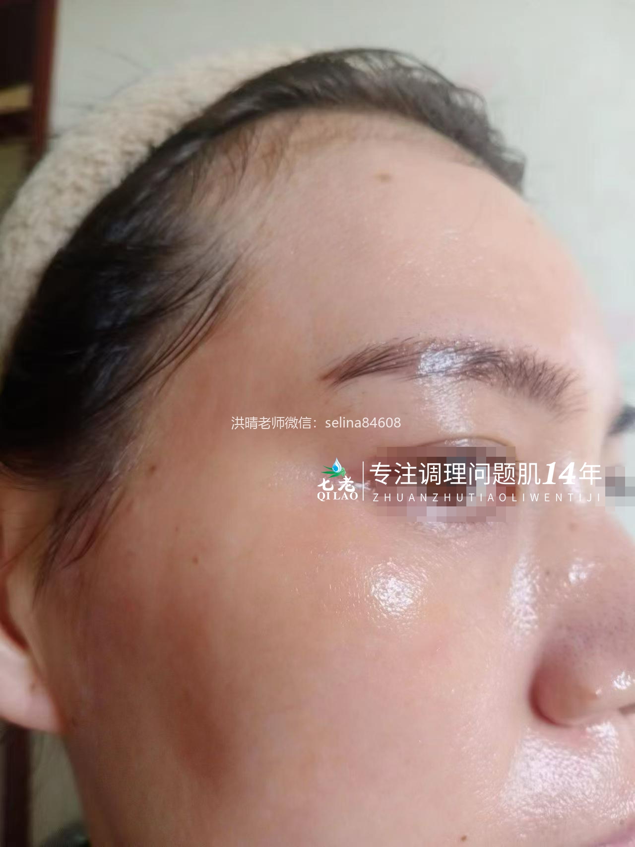七老新品金线莲内测超级顽固痘痘➕脂皮17天反馈