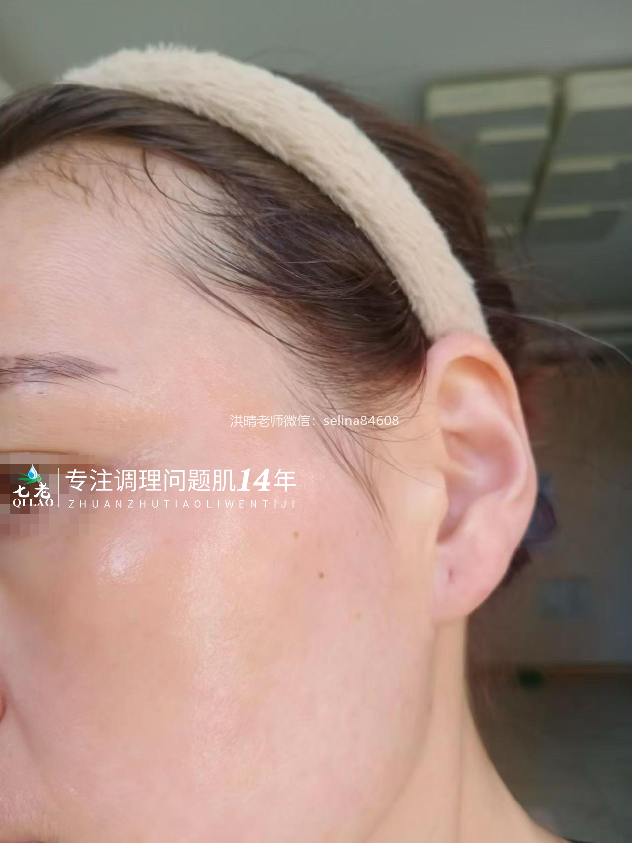 七老新品金线莲内测超级顽固痘痘➕脂皮17天反馈