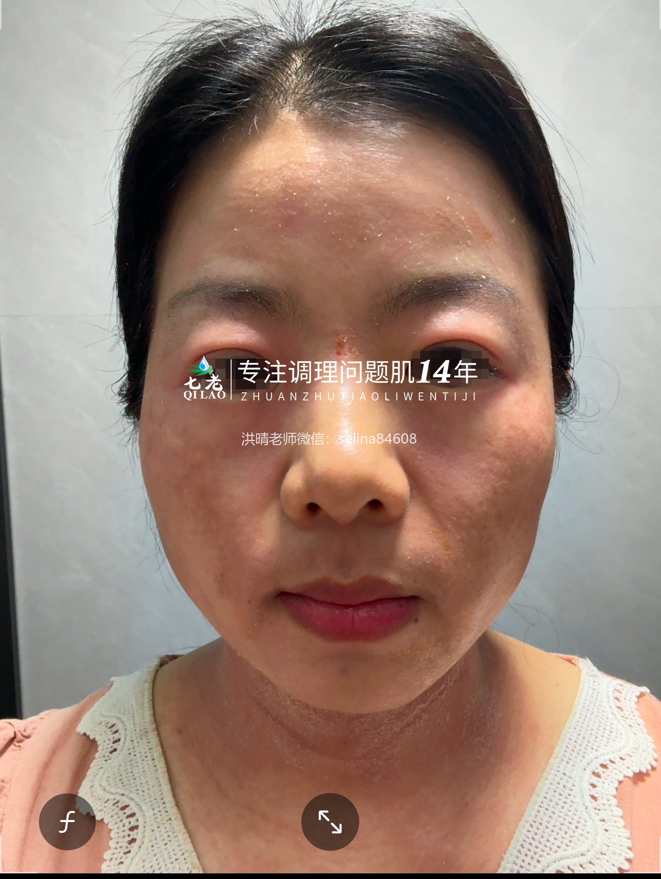 七老激素脸修护案例→全脸脖子红肿痒疹子爆皮