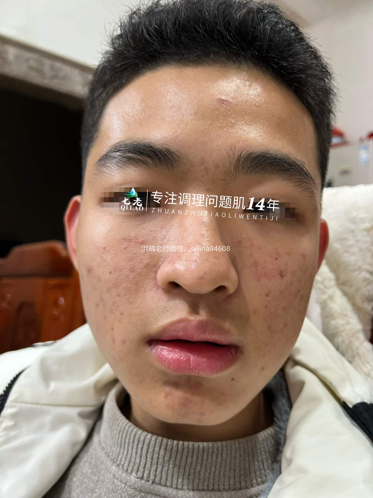 七老青春痘修护调理案例