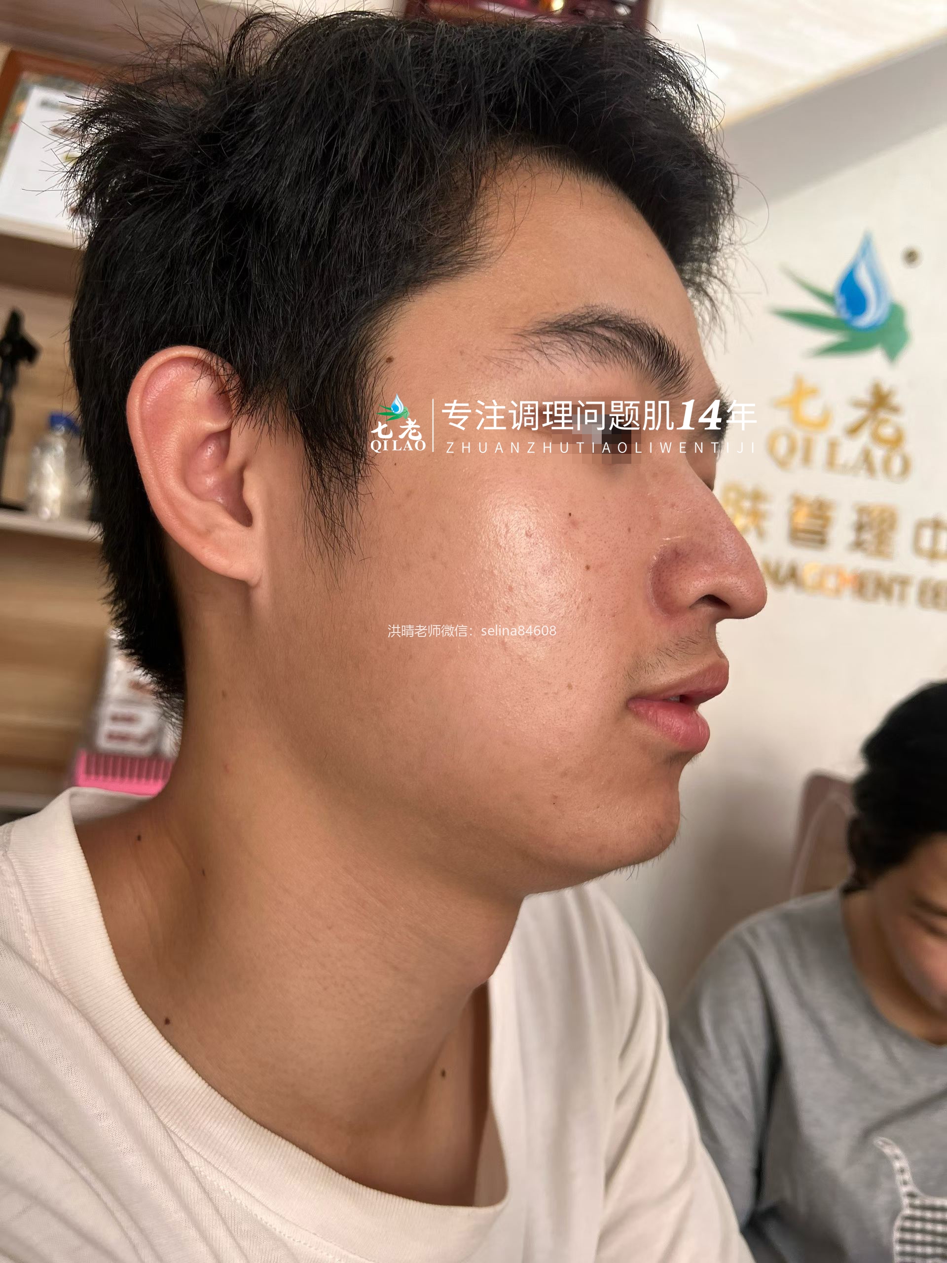 七老青春痘修护调理案例
