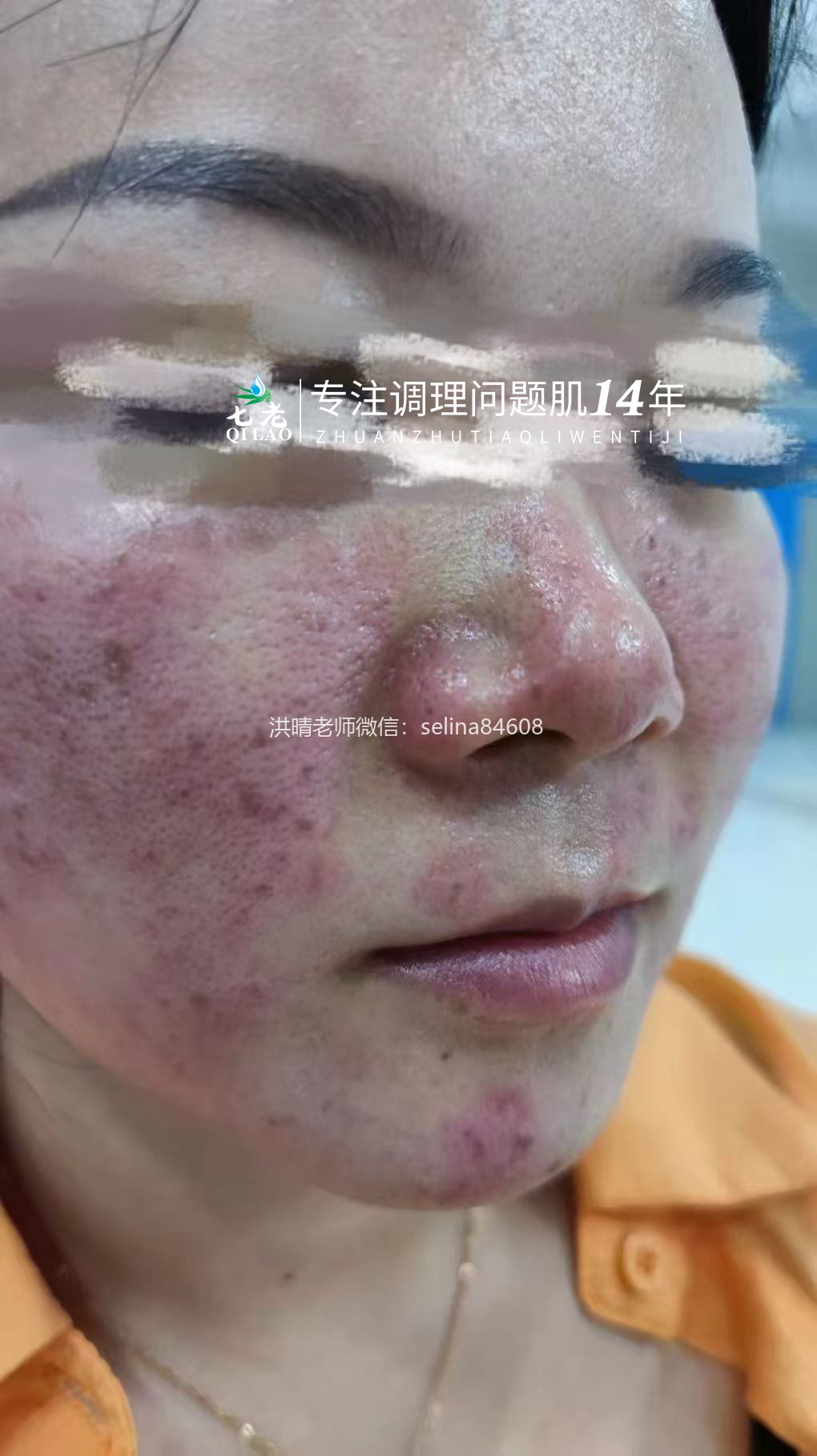 七老胶原水光→用过都会爱上