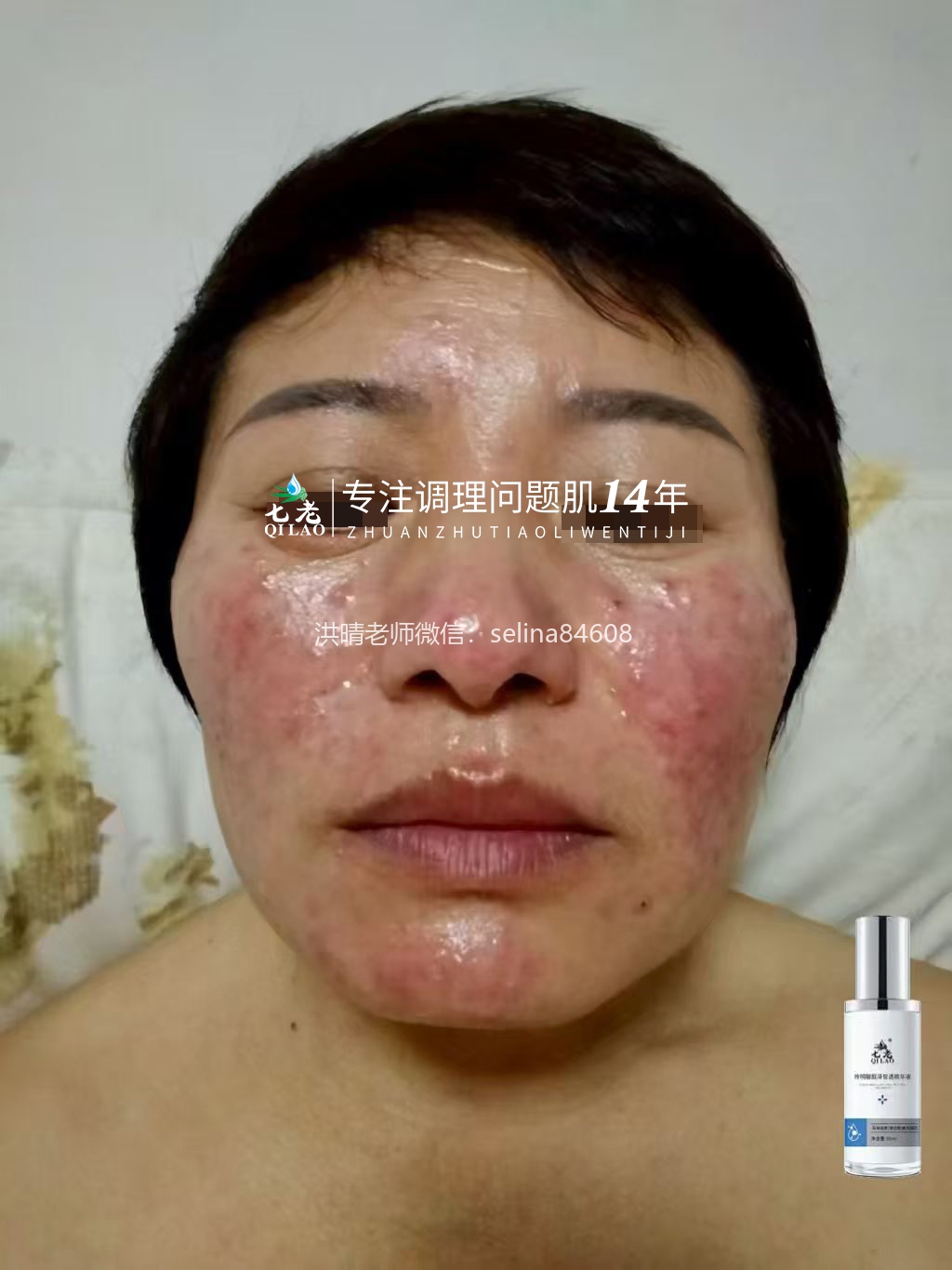 七老严重玫瑰脸玫瑰痤疮逆袭案例