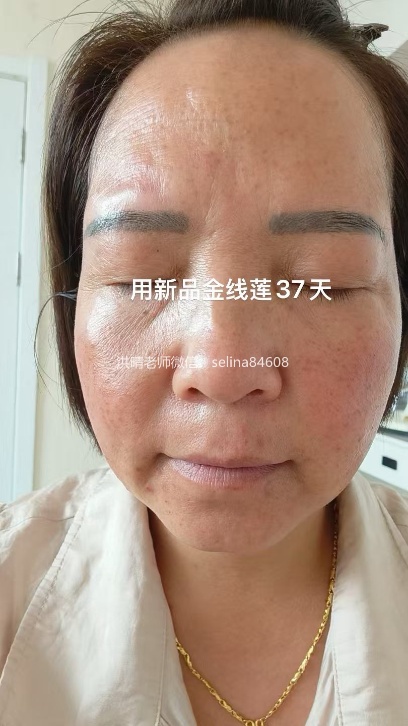 七老玫瑰痤疮用新品金线莲系列内测反馈