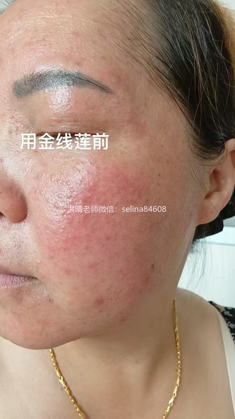 七老玫瑰痤疮用新品金线莲系列内测反馈