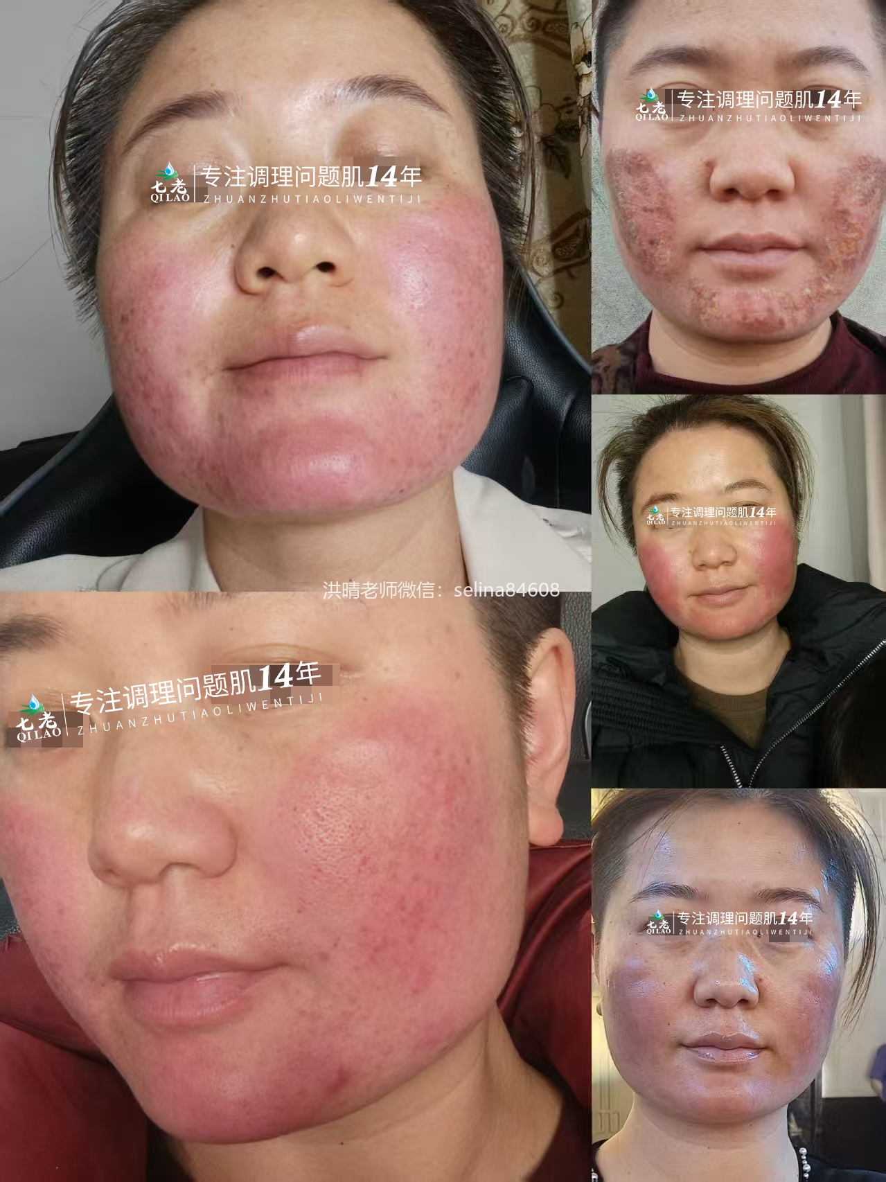 七老激素脸修护案例