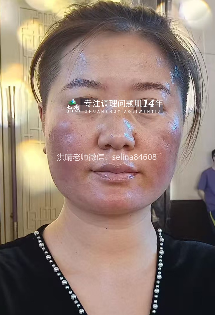 七老激素脸修护案例
