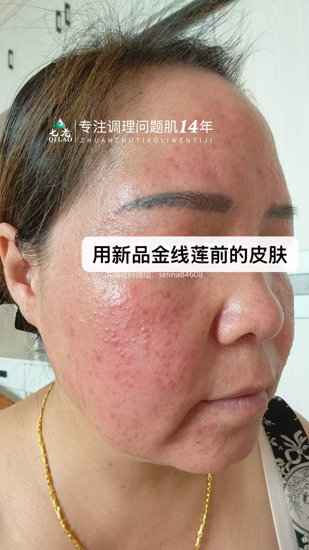 七老金线莲新品内测案例