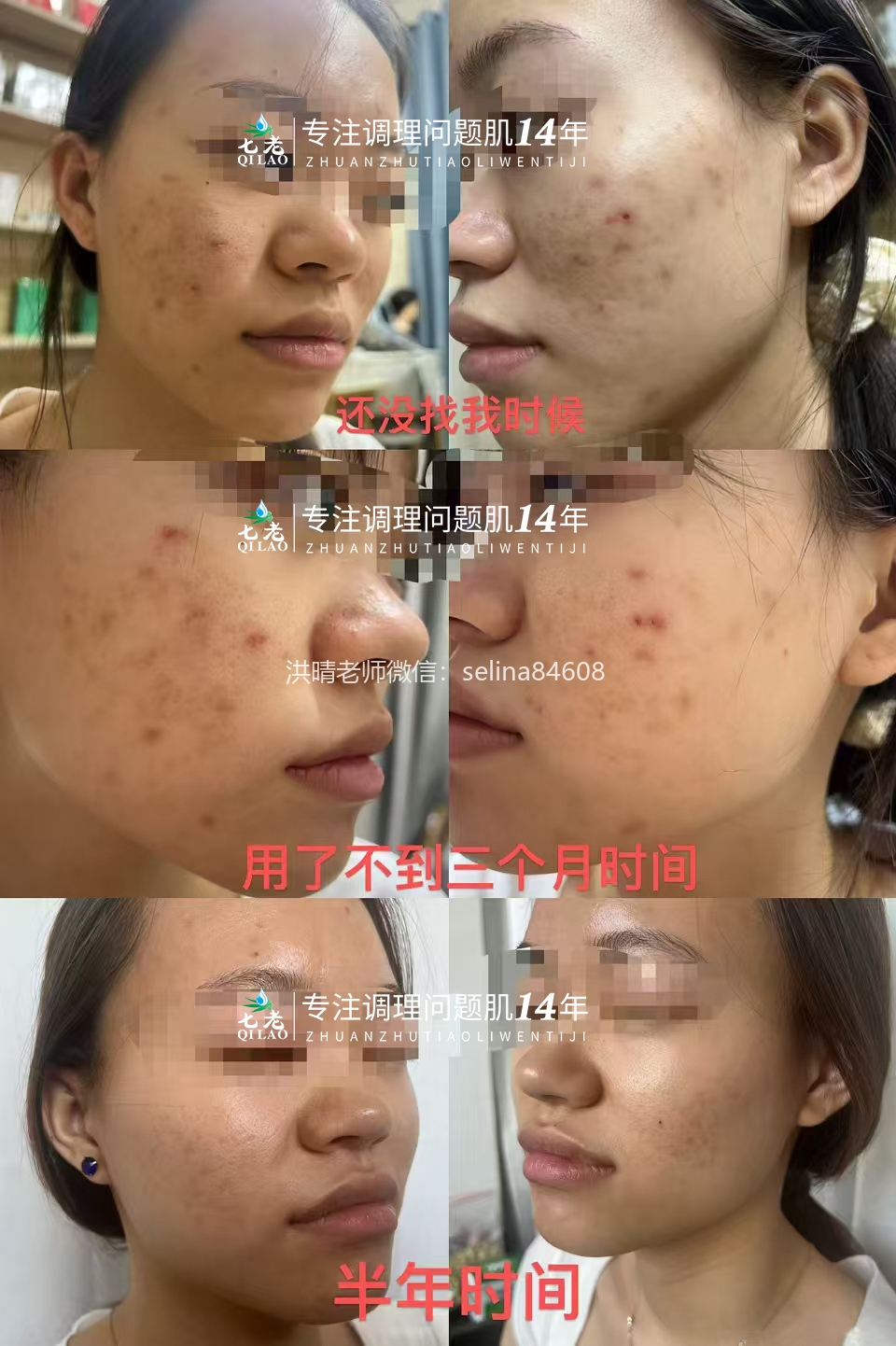 七老痘痘修护案例