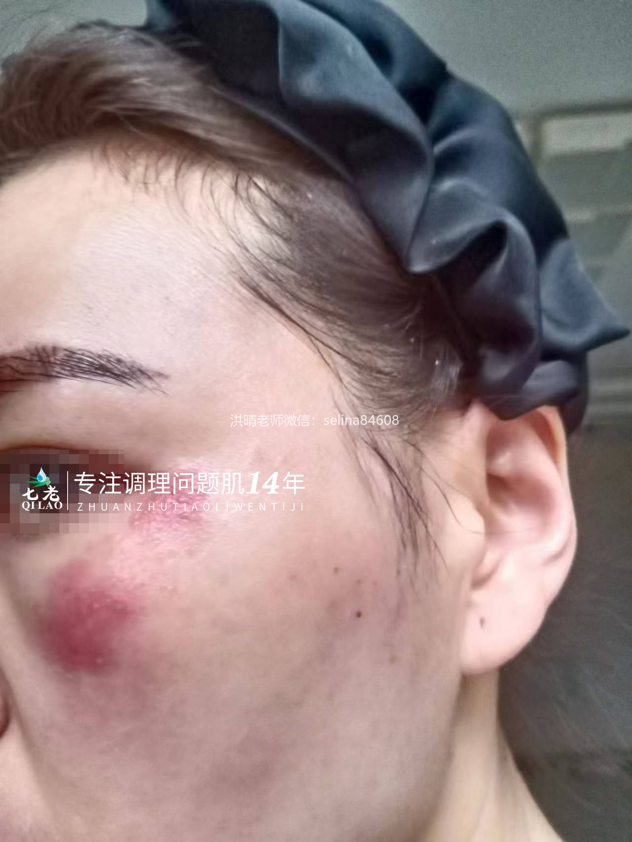 七老新品金线莲内测超级顽固痘痘➕脂皮17天反馈