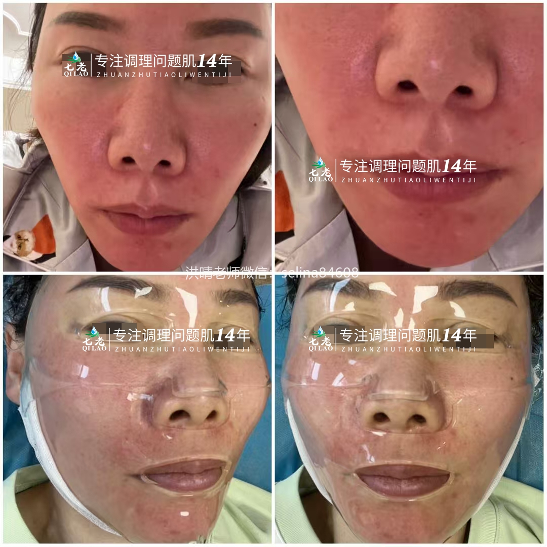 七老玫瑰痤疮正向案例反馈