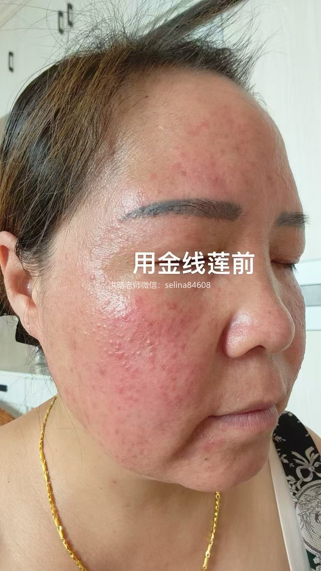 七老玫瑰痤疮用新品金线莲系列内测反馈