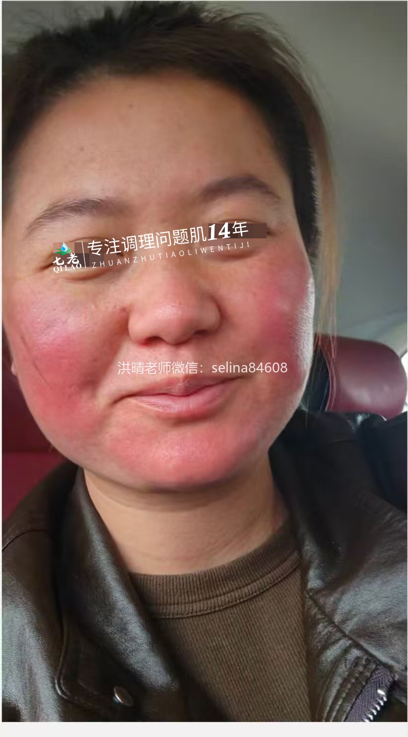 七老激素脸修护案例