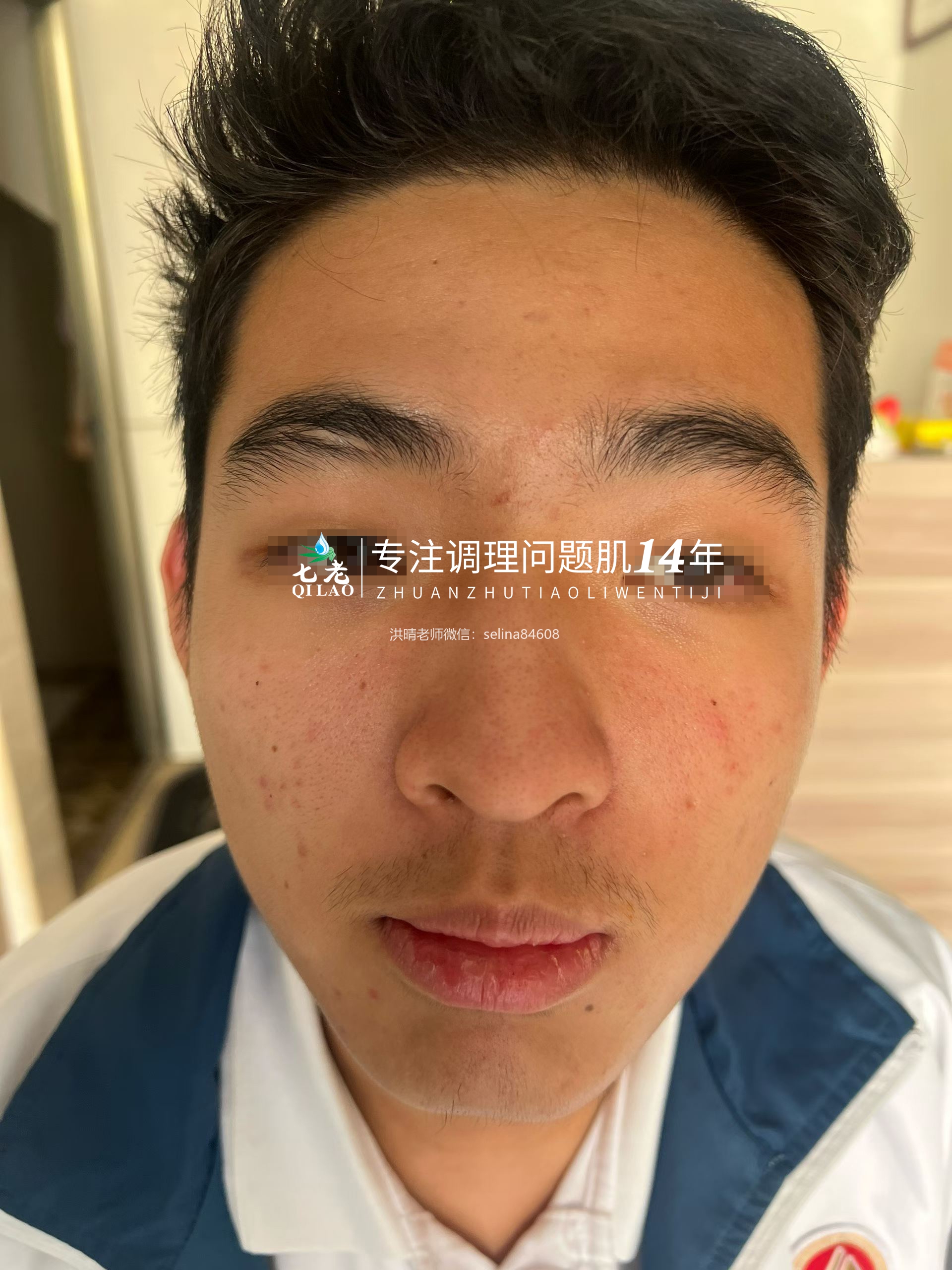 七老青春痘修护调理案例