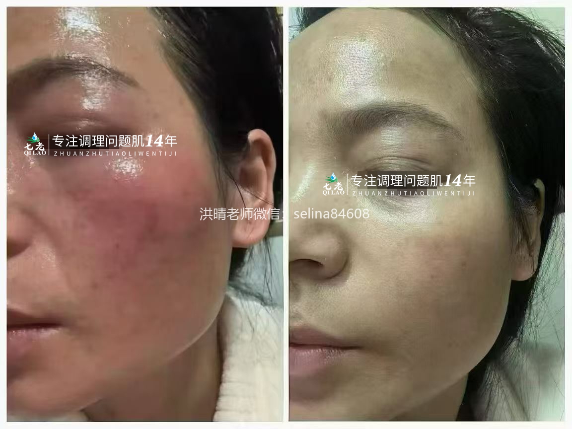 七老敏感泛红过敏依克多因霜修护案例