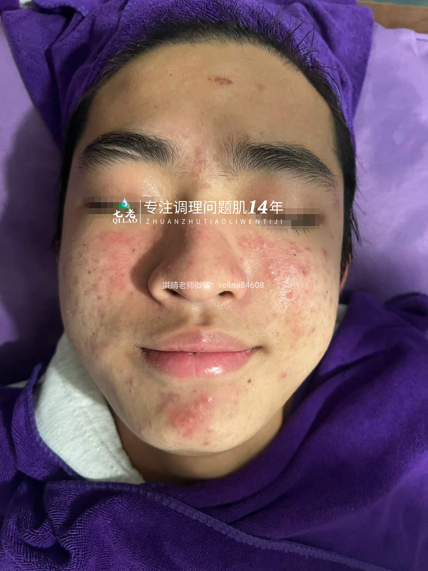 七老青春痘修护调理案例