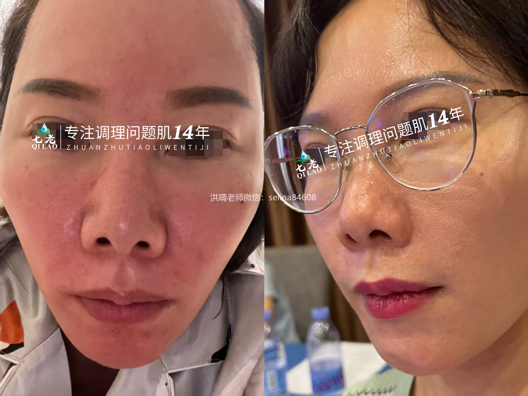 七老玫瑰痤疮正向案例反馈