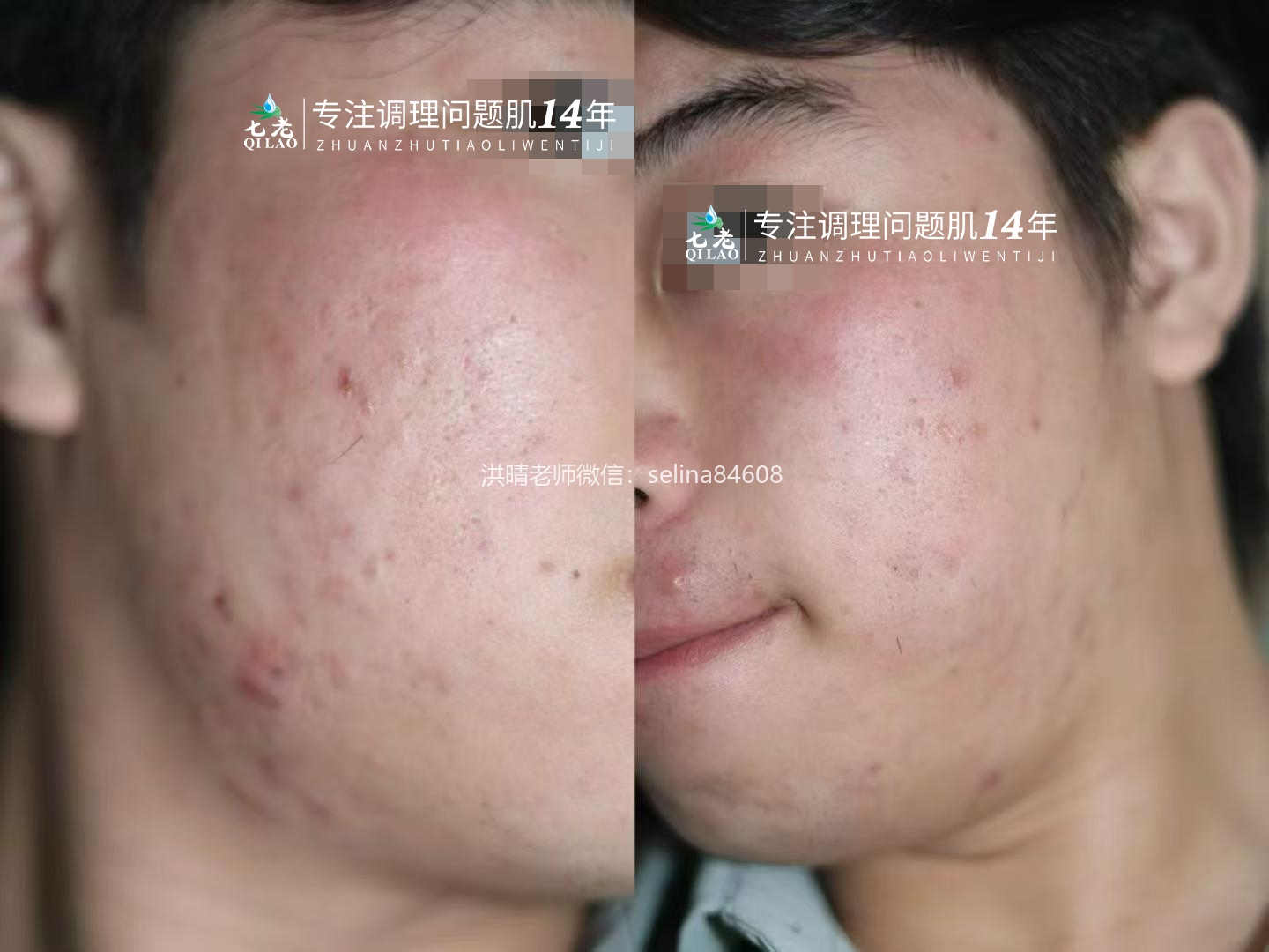七老青春痘修护案例