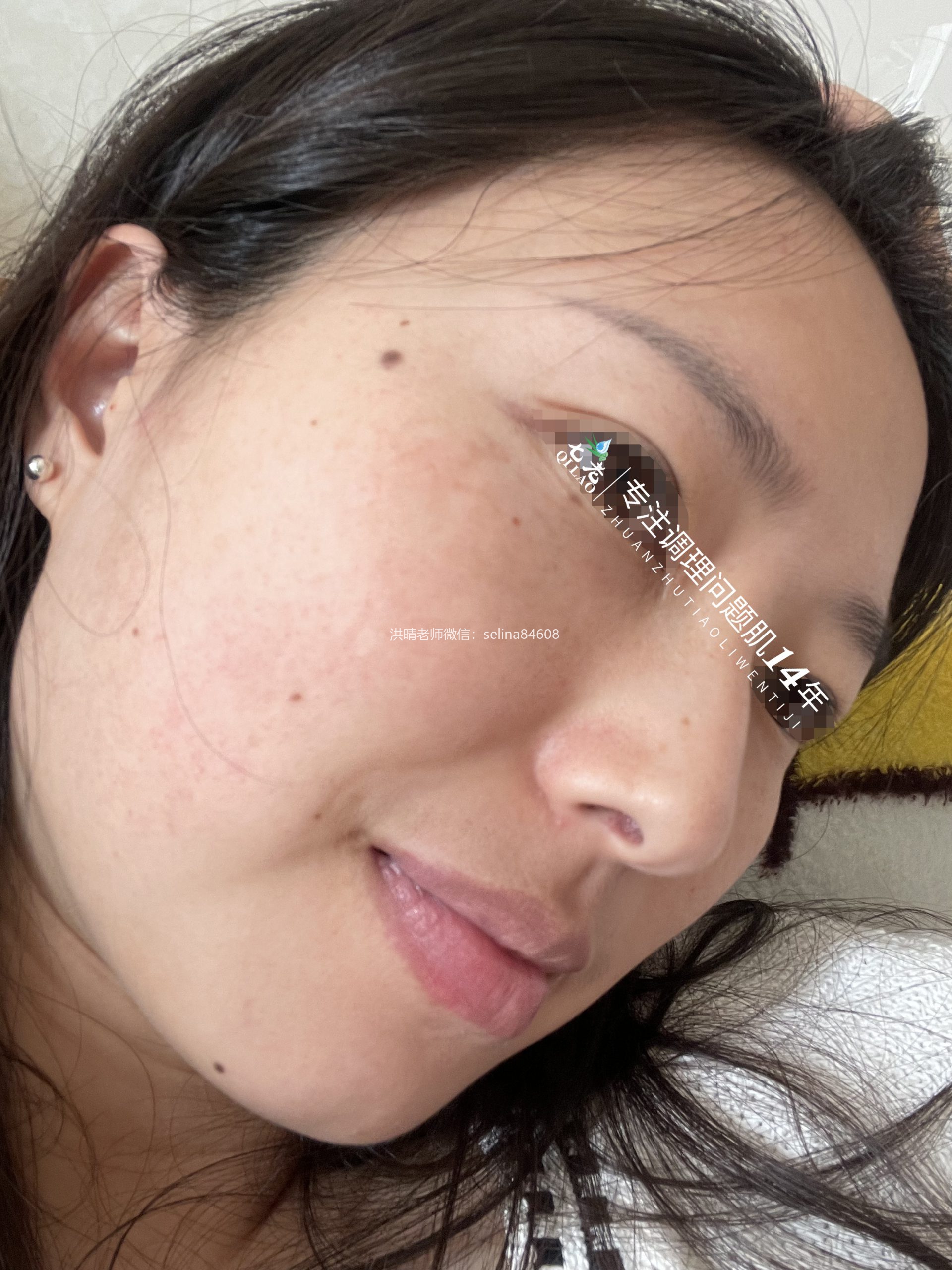 七老激素脸玫瑰痤疮脂溢性皮炎修护案例
