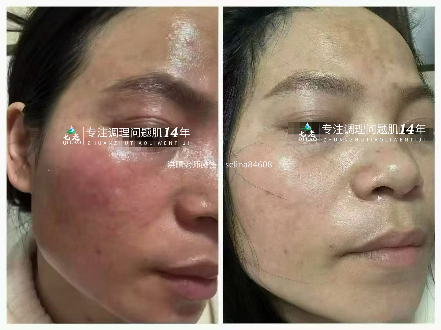 七老敏感泛红过敏依克多因霜修护案例