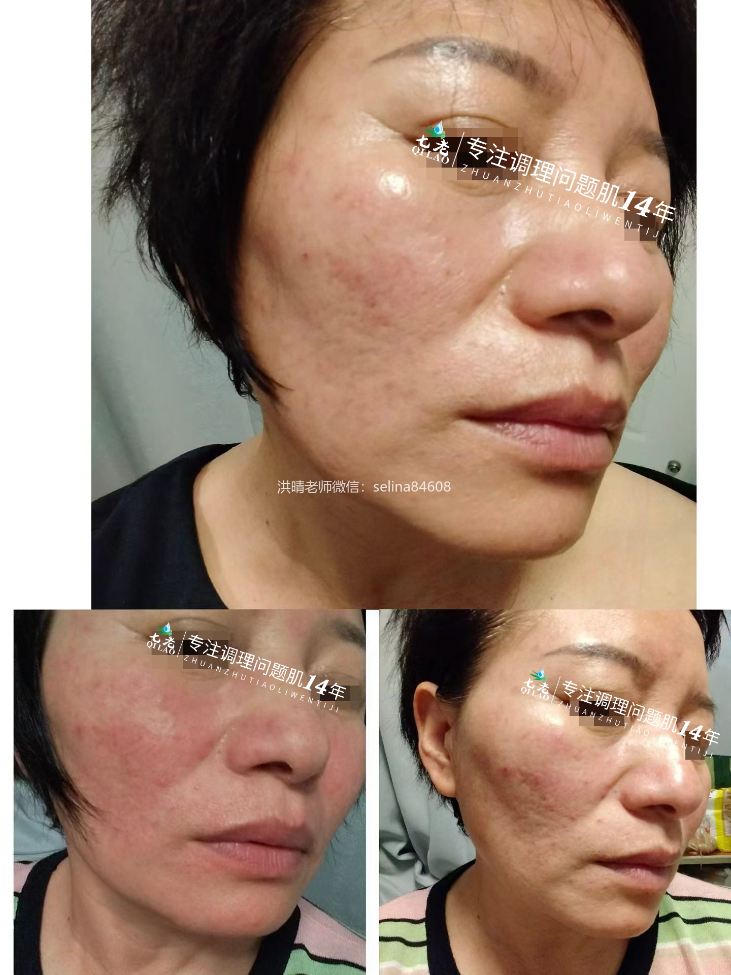 七老严重玫瑰脸玫瑰痤疮逆袭案例