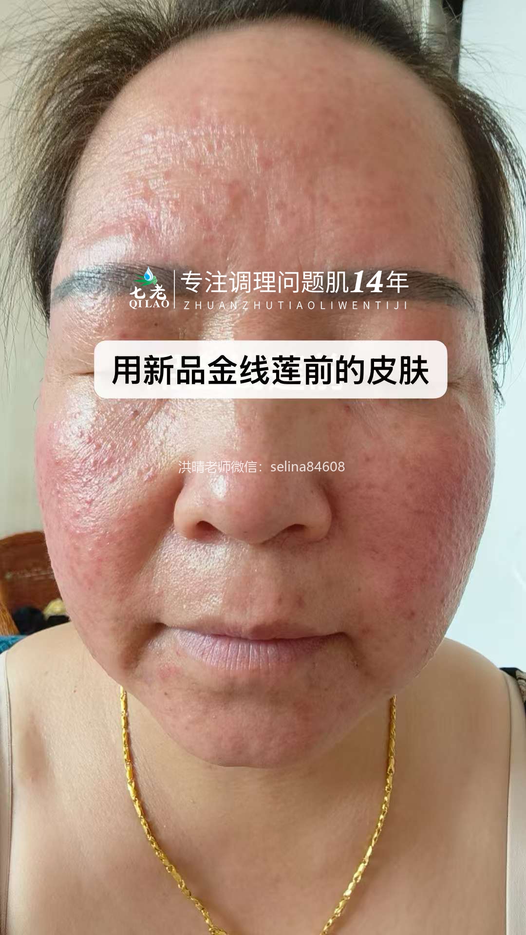 七老金线莲新品内测案例