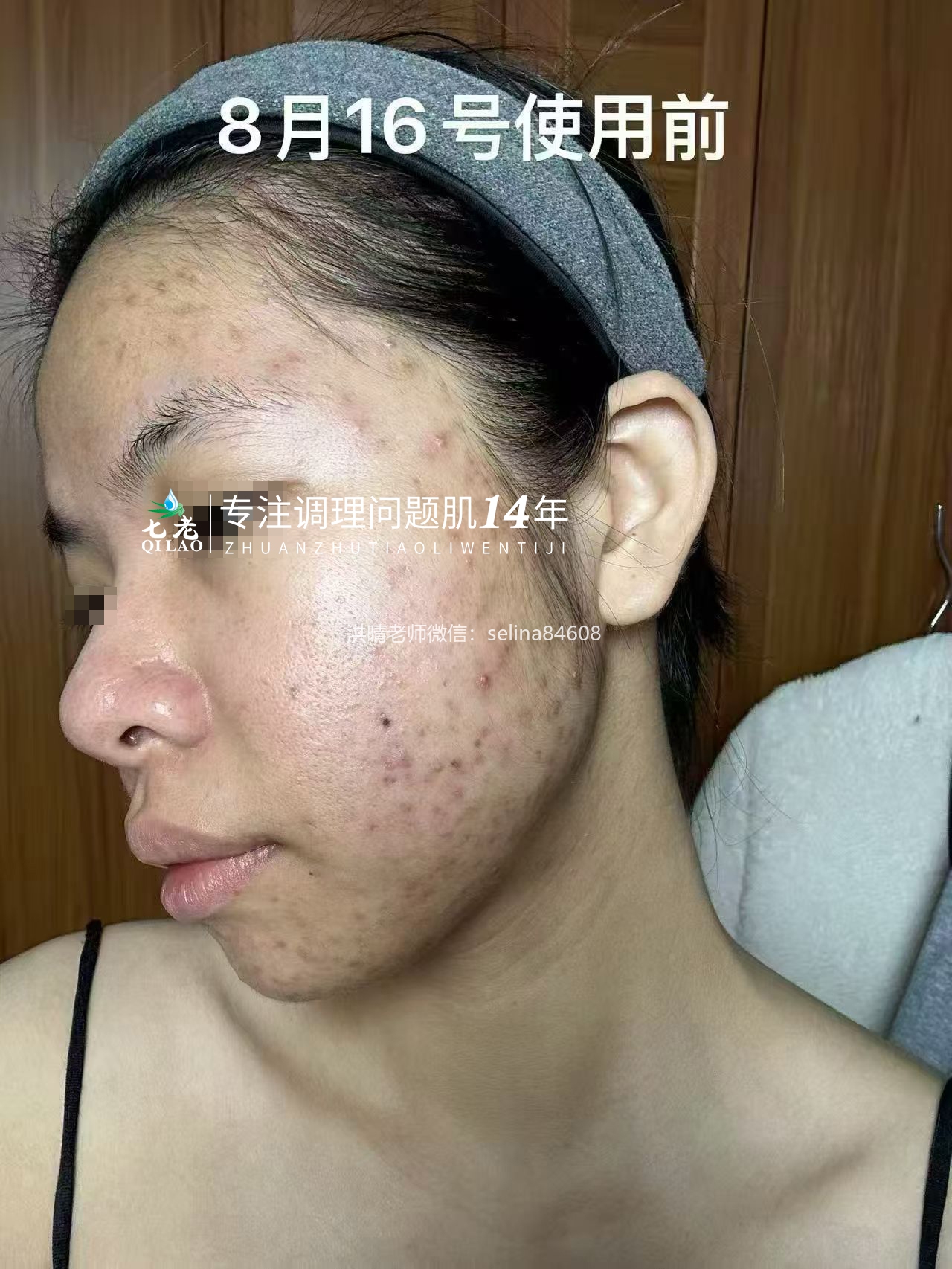 七老新品金线莲内测油敏疹子痘痘修护案例