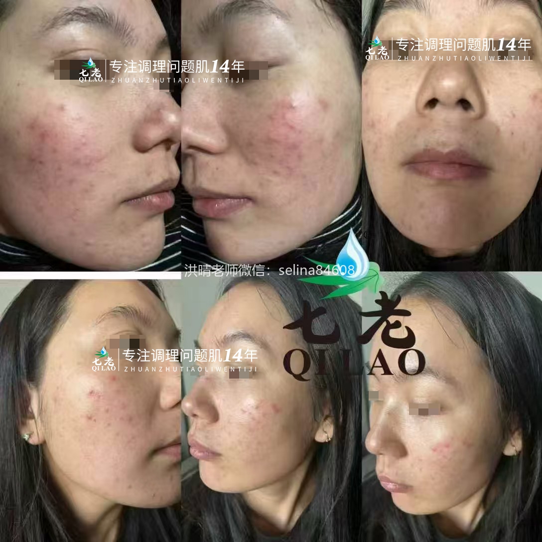 七老红烫痒疹子修护案例