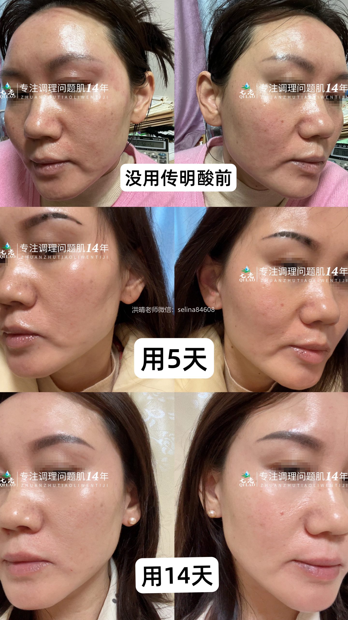 七老传明酸→敏感肌黑红脸色沉黑斑必备