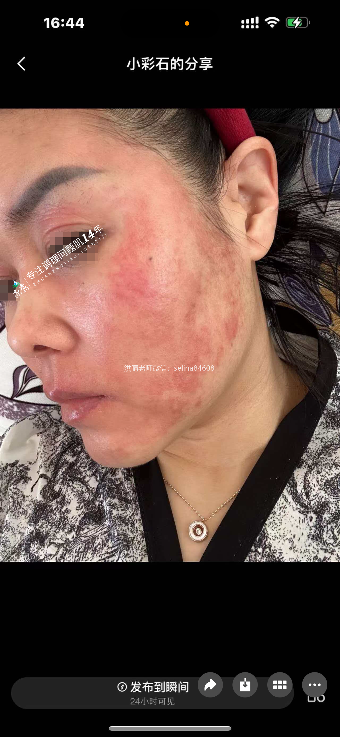 七老激素脸红烫痒修护案例