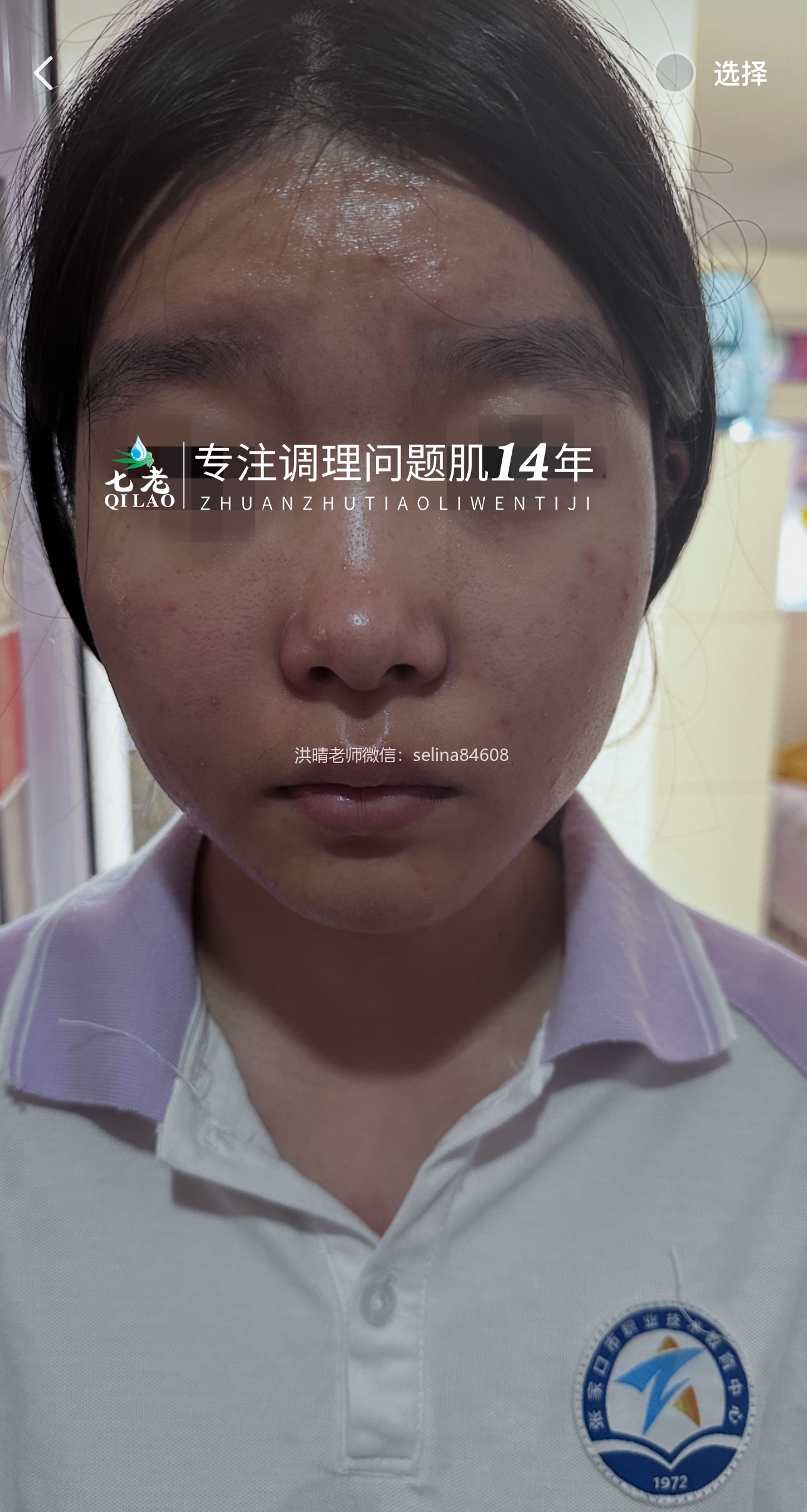 七老青春期青春痘修护案例