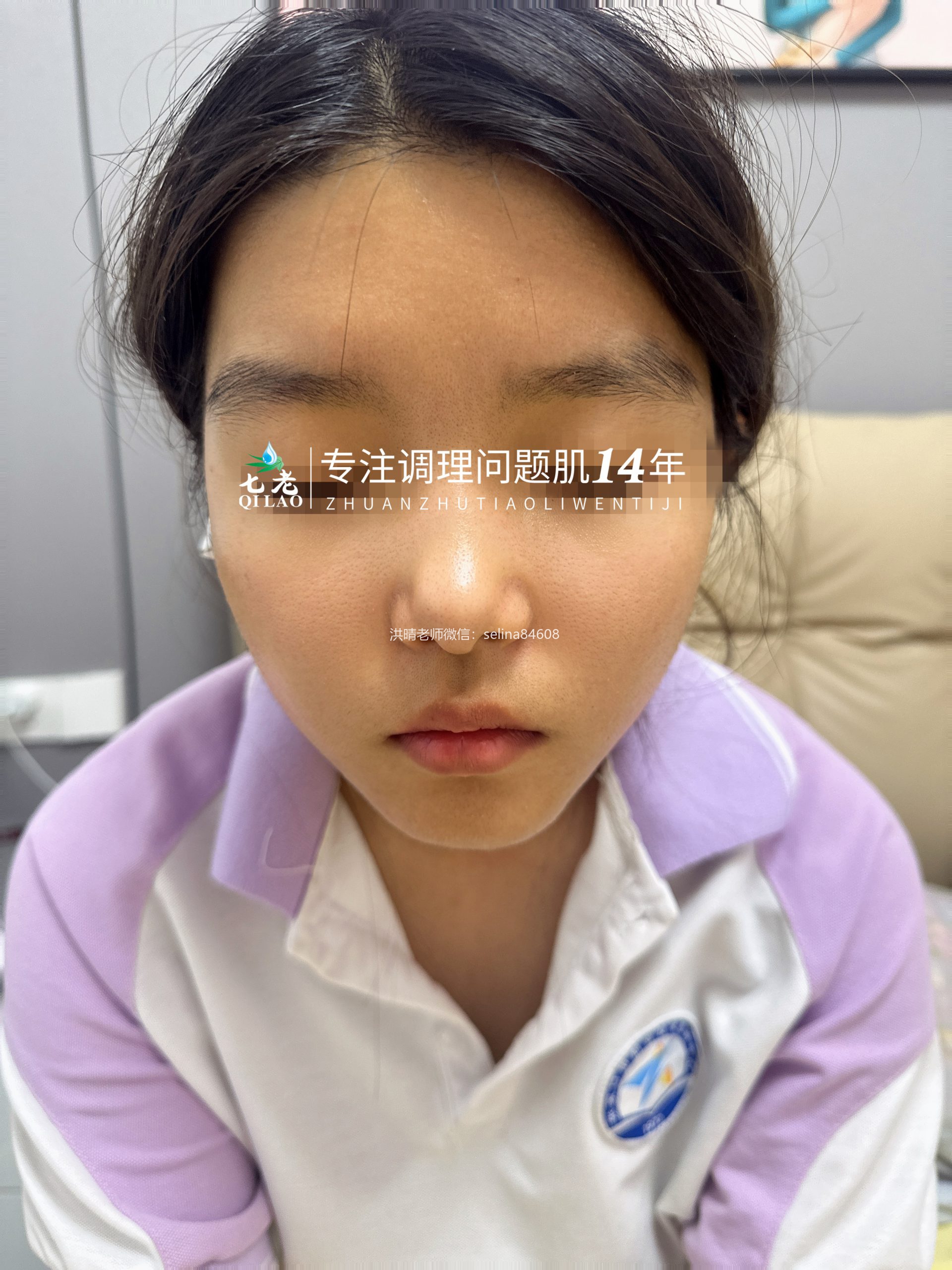 七老青春期青春痘修护案例