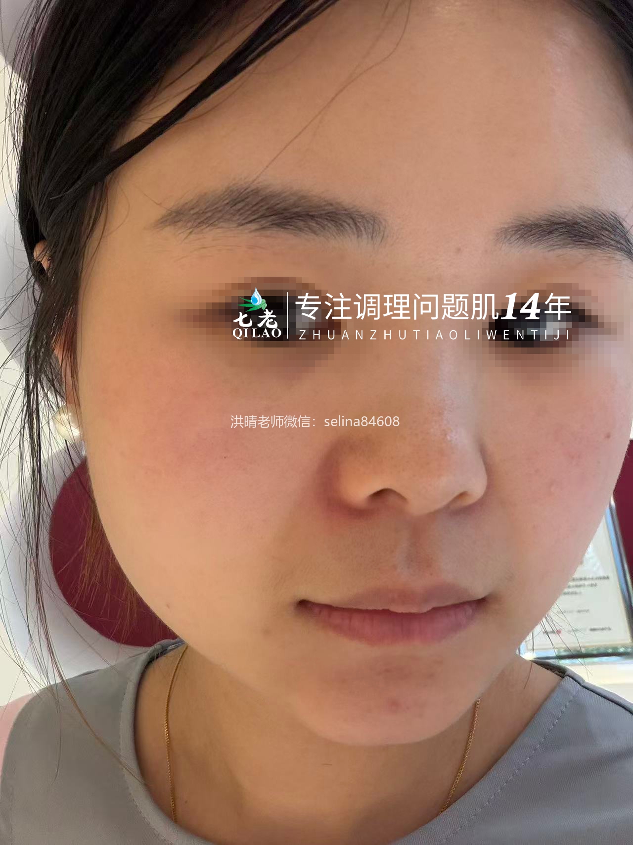 七老红烫痒痛疹子修护案例