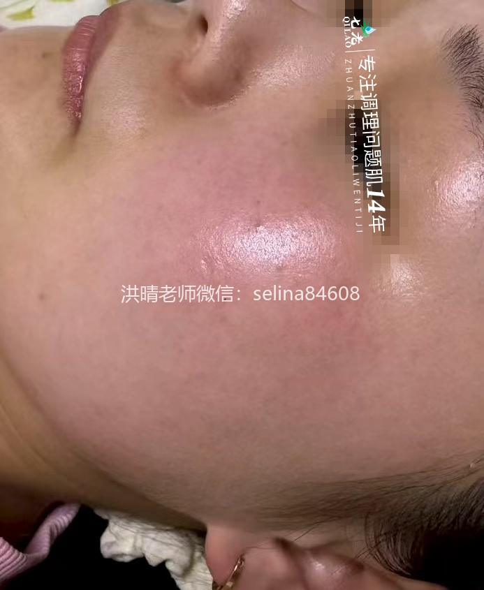 七老红烫痒痛疹子修护案例
