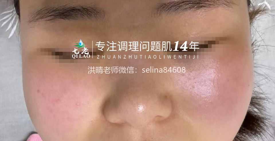 七老红烫痒痛疹子修护案例