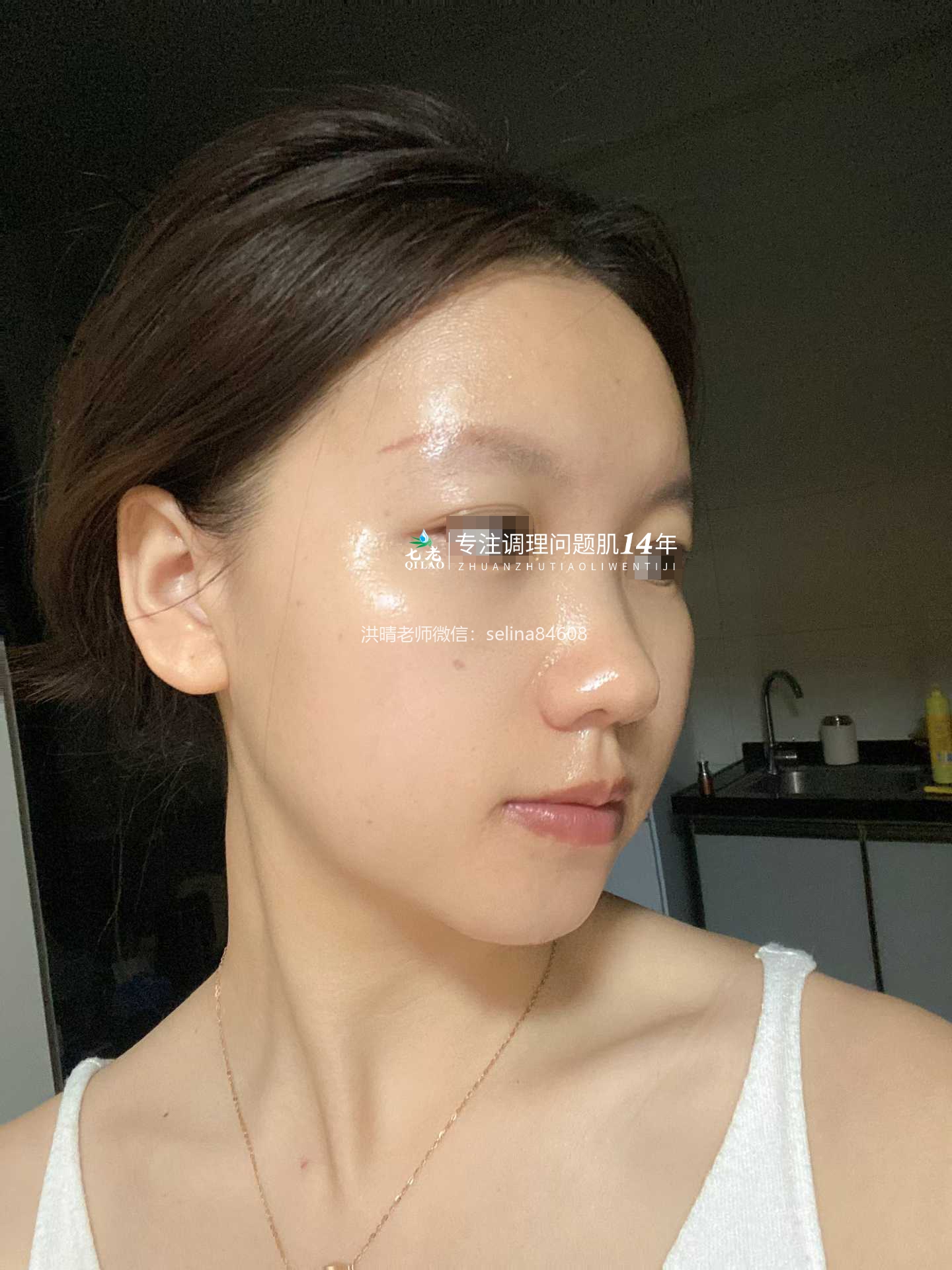 七老突发过敏修护案例