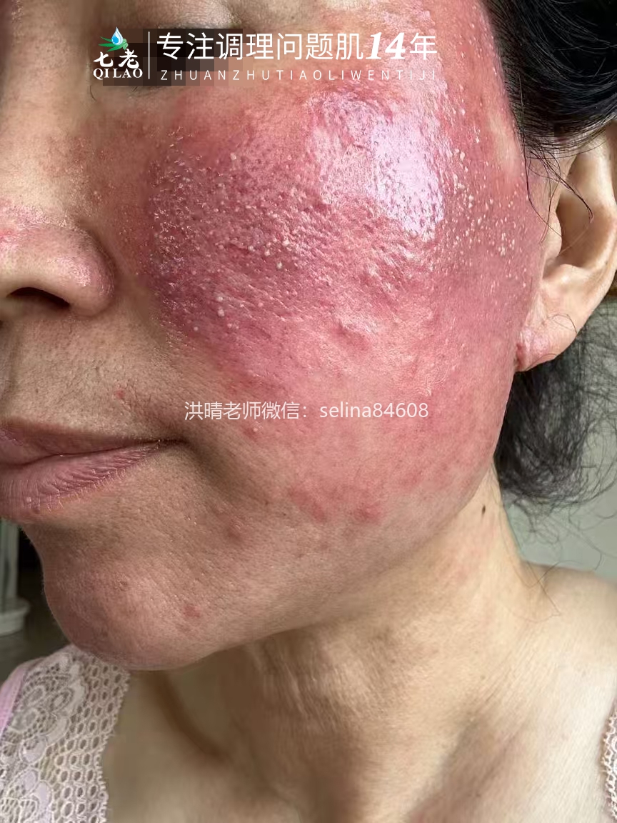 七老严重激素脸玫瑰痤疮修护案例